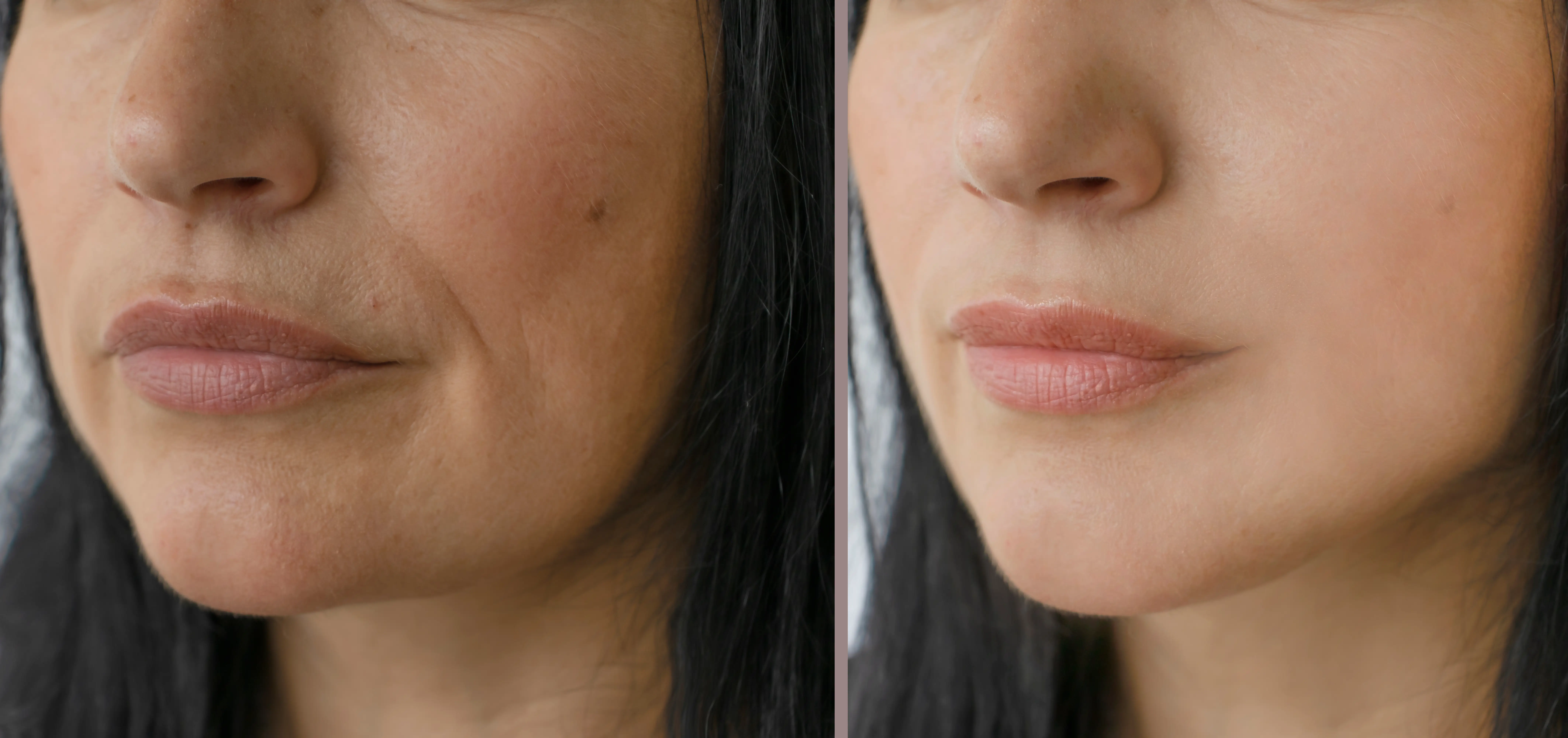 Side-by-side facial comparison showing differences in cheek and jawline skin texture