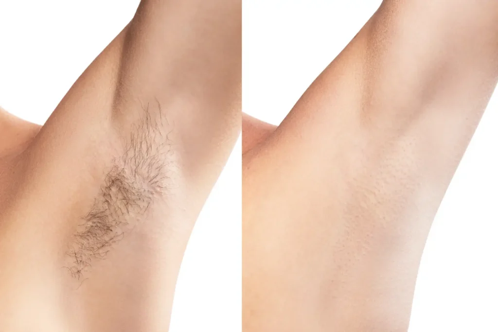 Left and right underarm images show visible hair on the left and minimal visible hair with follicle dots on the right.